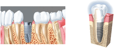 Exemple d'implant dentaire en 3D
